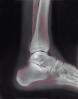 leg, foot, X-Ray, HASV01P10_09.2014