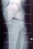 knee, X-Ray, HASV01P10_14