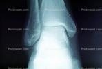 ankle, X-Ray, HASV01P10_17