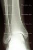 ankle, X-Ray, HASV01P10_18