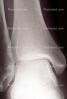 ankle, X-Ray, HASV01P10_19