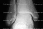 ankle, X-Ray, HASV01P11_01