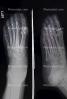 foot, toes, X-Ray, HASV01P11_03.2014