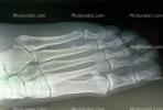 foot, toes, X-Ray, HASV01P11_04