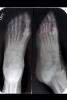 foot, toes, X-Ray, HASV01P11_06.2015