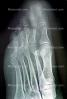 foot, toes, X-Ray, HASV01P11_07