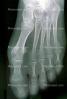 foot, toes, X-Ray, HASV01P11_08