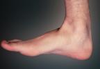 Foot, Toes, Joints, Ankle, Heal, Skin, Epidermis, HASV01P15_13