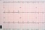 Heart and Pulse rate chart, ECG, HDEV01P03_02
