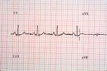 Heart and Pulse rate chart, ECG, HDEV01P03_04