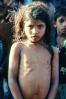 Malnutrition, Hungry, Ribs, Malnourished Girl, Mumbai, India