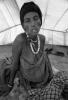 Tuberculosis, Refugee Camp, near the Ethiopia Somalia border, African Diaspora, Somalia, POV35V07P43_19